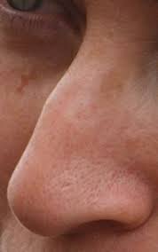 Nose